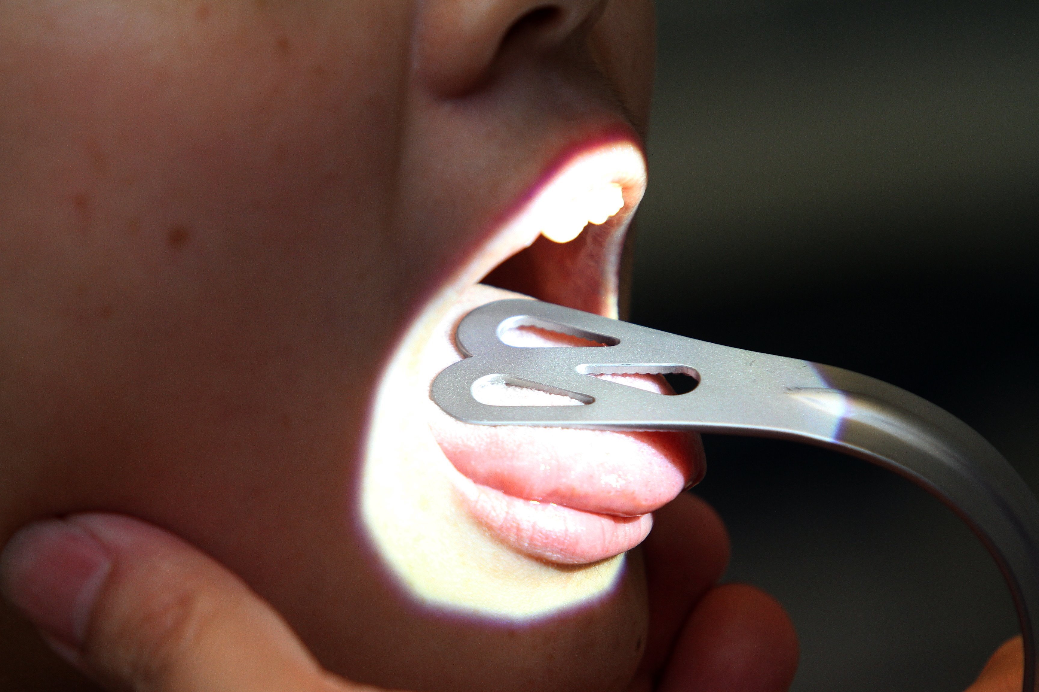 口交或增罹患机率 舌癌患者年轻化 地方 大北马 星洲网sin Chew Daily