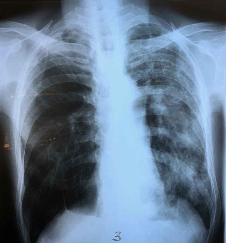 左肺部侵润性和结核现象。（图三）