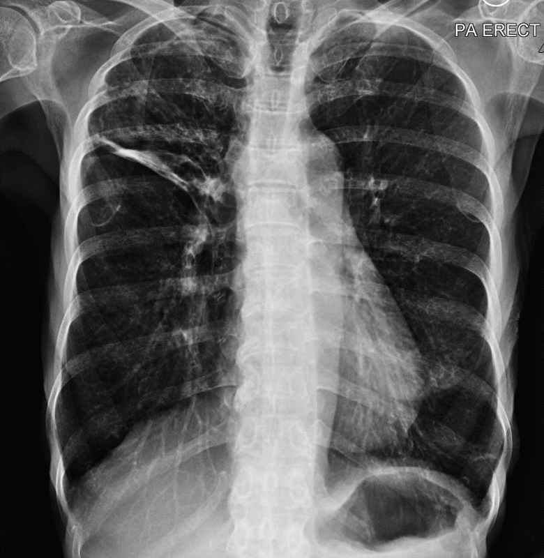 需要进一步诊断是不是肺痨的肺部右上部侵润性现象。（图二）