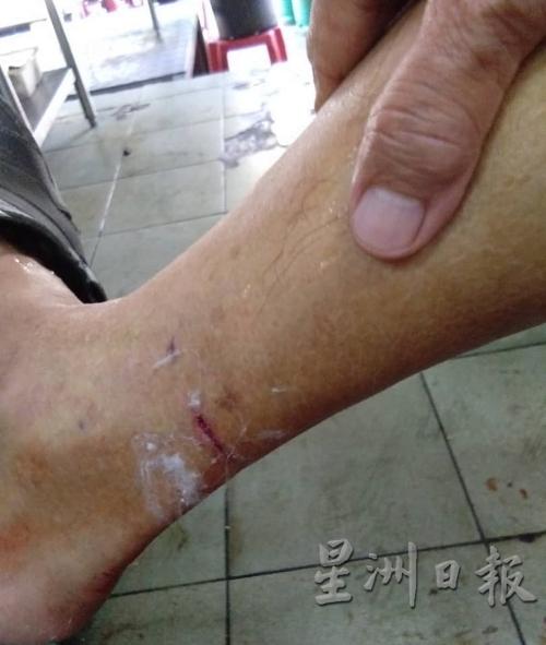 王茂民的右脚踝被狗咬出一道伤口。(图:星洲日报)