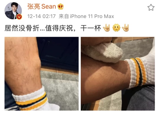 张亮更新了微博，发布了两张图，可怜兮兮自曝差点骨折，不过幸好他的脚只是肿了一块，伤得并不重。