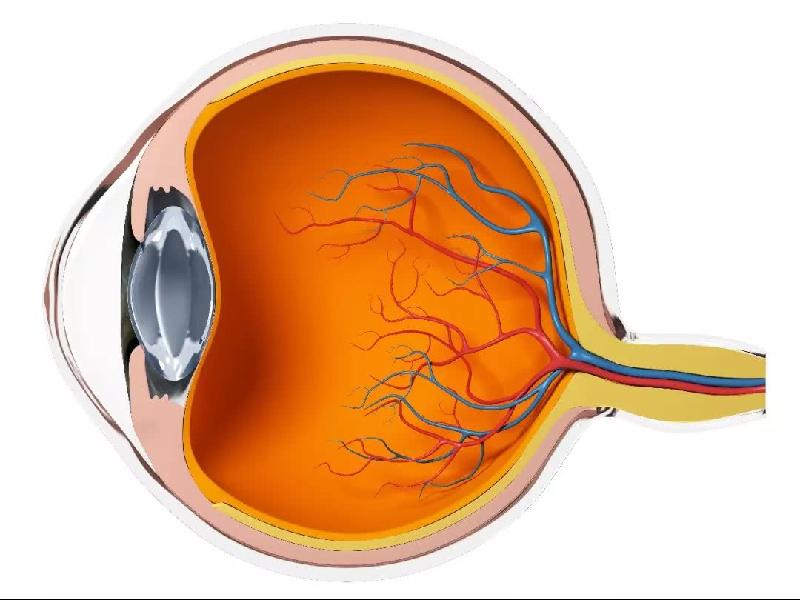 青光眼是导致成人失明的其中一个原因，是不可逆转的视神经病变。