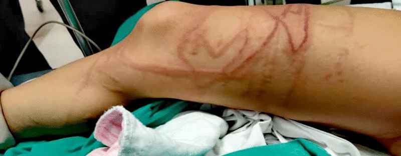 中国女童被水母蜇伤，手脚出现多条红痕。