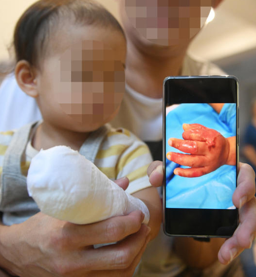 家人抱着包扎好伤口的女婴，出示女婴手被烫伤的手机荧幕照片。