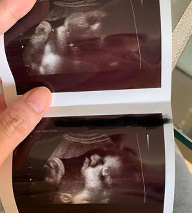 叶翠翠展示“三王子”的超声波照片，预告是巨婴。
