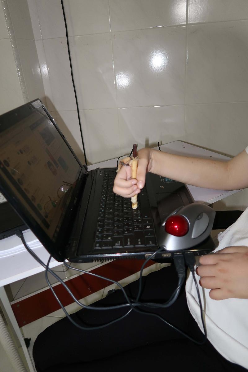 
郑楚筑用辅具套手，在电脑键盘上打字。