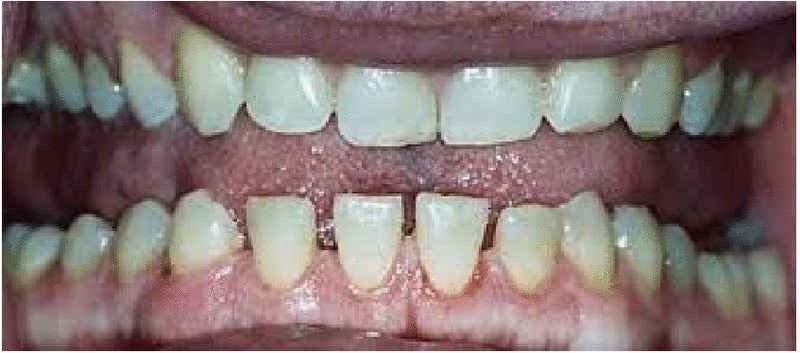 肢端肥大症也会造成牙齿稀疏和咬合不良。（图片取自互联网）