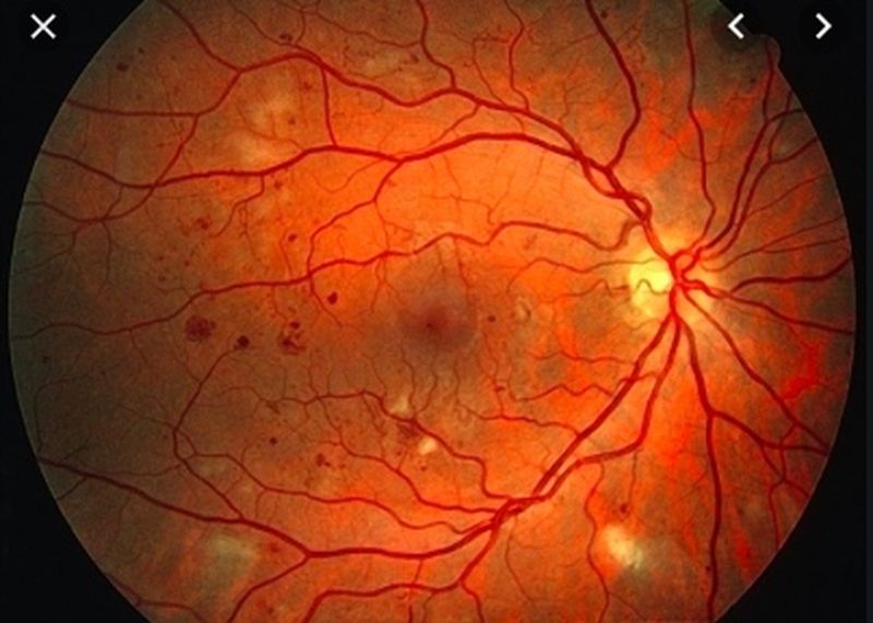 糖尿病患者在初期可见其眼睛的细小血管爆裂。

