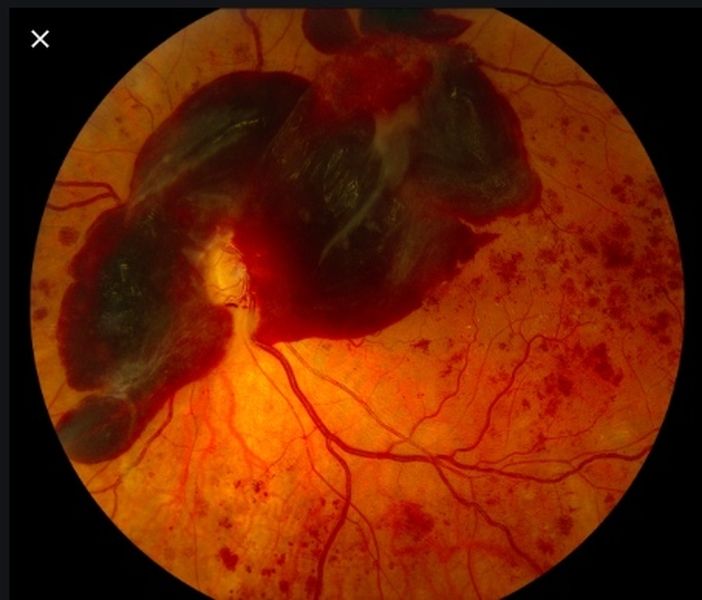 晚期糖尿病患者的眼睛内部严重血管爆裂及出血。
