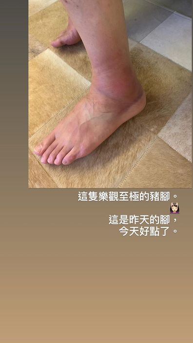 黄翠如最关心是老公日前扭伤的脚尽快消肿。