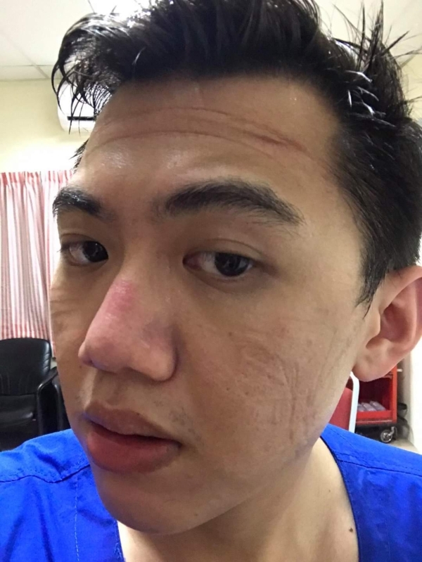 薛佳盛加入抗疫前线，可见个人防护用具在他脸上留下的痕迹。