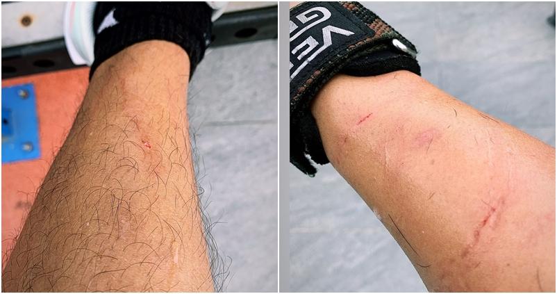 方力申的手臂有几道被爱犬咬伤的伤痕。