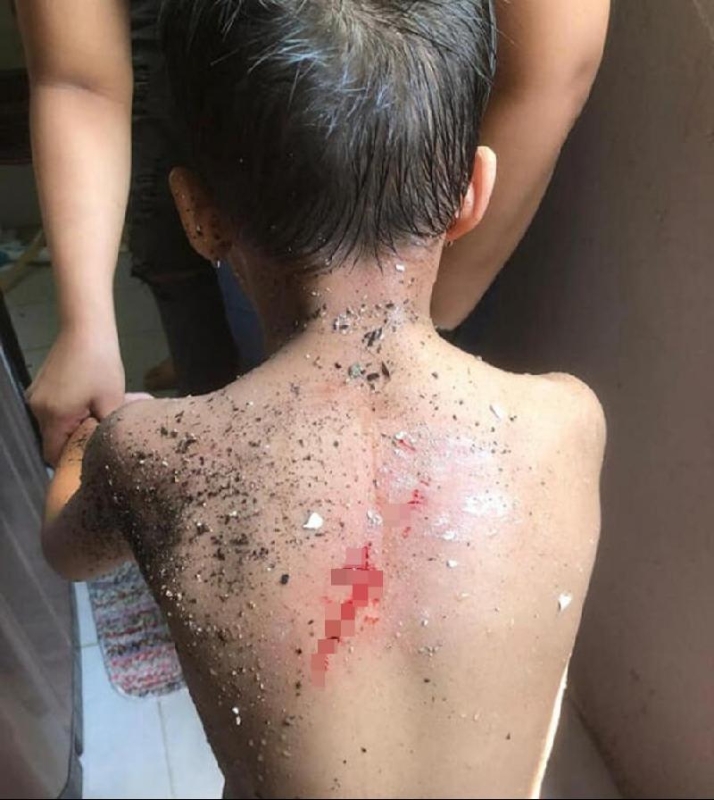 男童背部被石灰块击中后受伤流血。