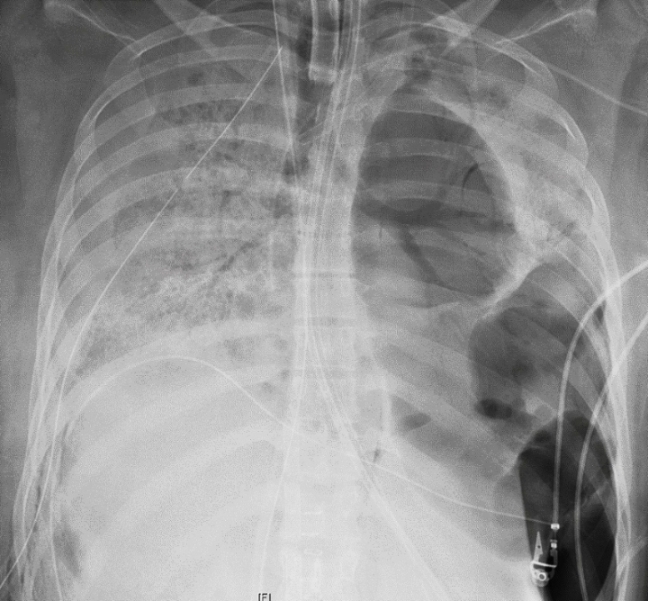 图为患者已受损的胸腔X光影像。（图：美联社）