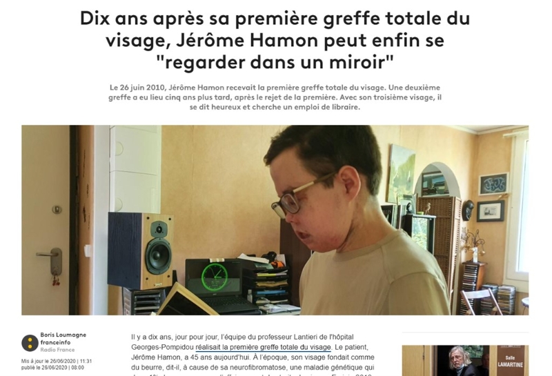 法国男子阿蒙因罹患罕见疾病，花了10年拥有3张脸，直到今日终于能在镜子里正视自己。（图取自法国新闻电台网页francetvinfo.fr）