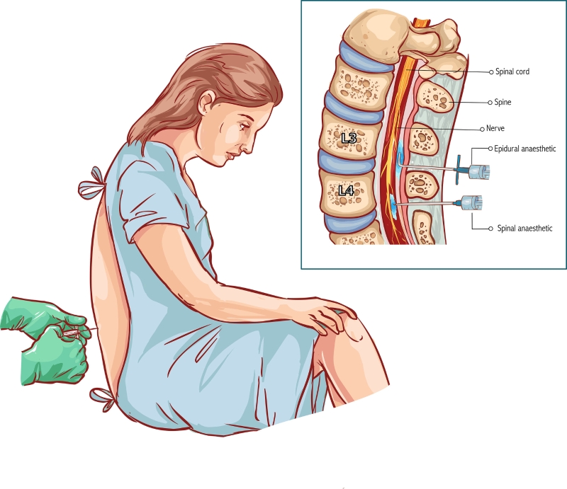 硬脊膜外麻醉是局部麻醉的一种,透过导管将药物注射在硬脊膜外间隙,从而让注射的部位失去感官知觉。