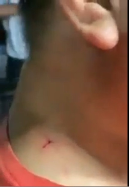 红衣小贩的颈项出现轻微的伤痕。