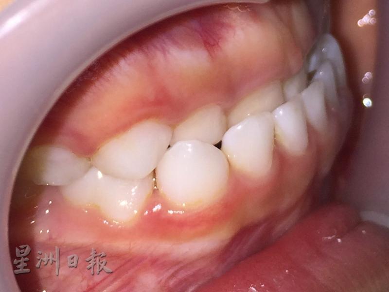 前牙反頜（地包天）問題，可在5-12歲之間的矯正黃金期，矯正頜骨發育，引導牙槽沿著理想的弓形方向發展。