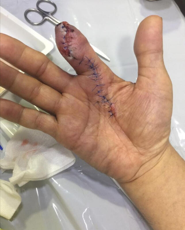 男子洗虾时被刺伤，隔天手指发黑，半截的食指被截掉。（图取自脸书）
