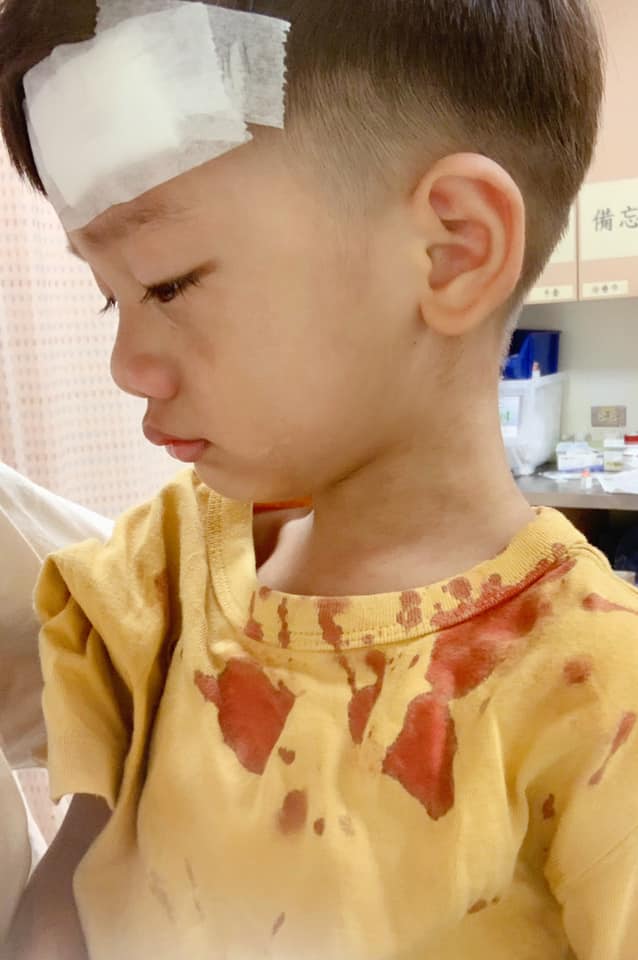 宥胜3岁的儿子剀剀撞破头。