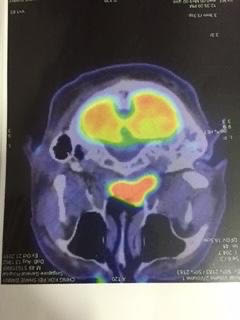 曾国辉说，图中黄色心形形状的就是在鼻子内的肿瘤，当时看到肿瘤的那一刻，他倍感绝望。（受访者提供）