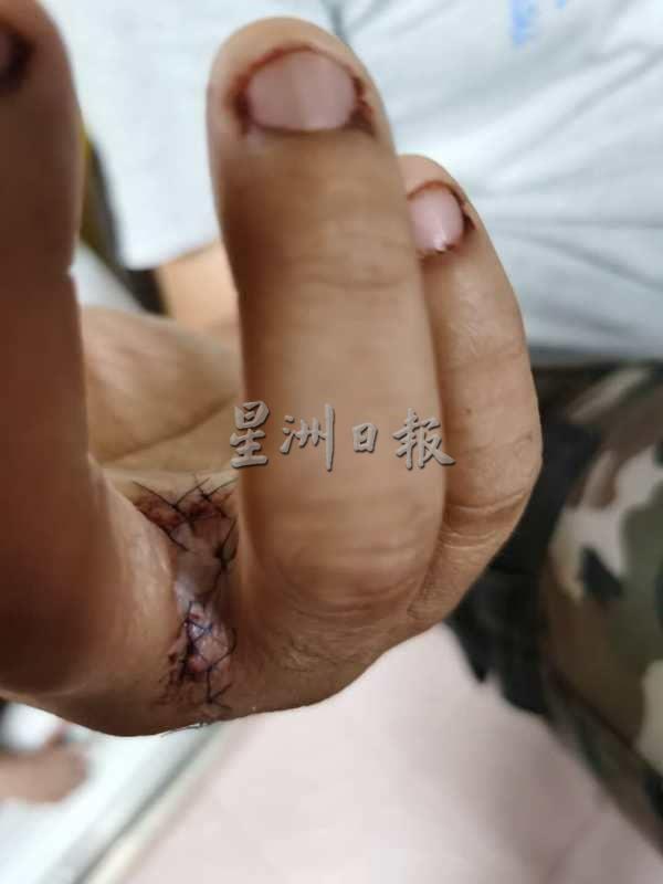 吴明杰友人被殴打受伤，需入院缝针。