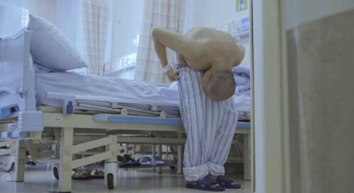 手术前的李华是世界罕见的“3-on折叠人”这种强直性脊柱炎会让四肢的大关节、脊柱的椎间盘纤维化及骨化，导致原本能灵活转动的部位逐渐变得僵硬。