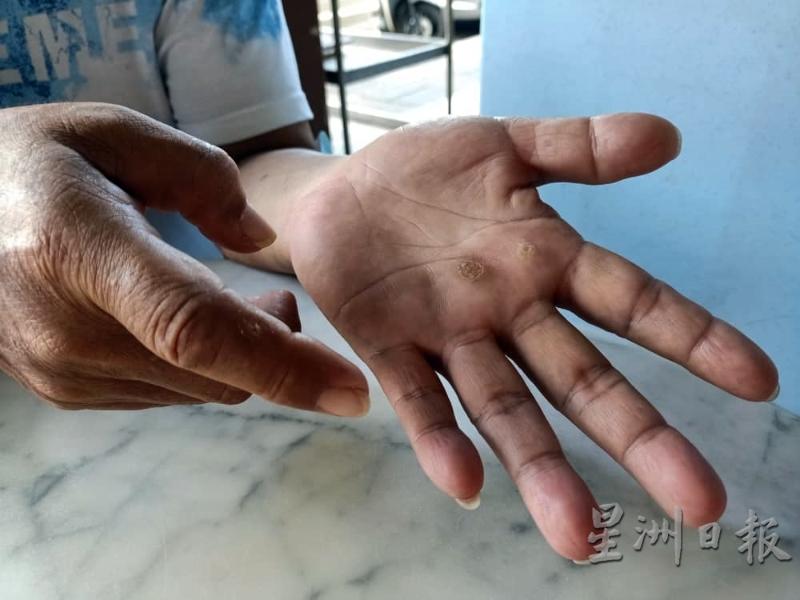 开大料到底苦到甚么程度，陈智盛出示了右手食指一侧的水泡，还有左掌厚皮硬茧，正是年复一年累积下来的岁月痕迹。