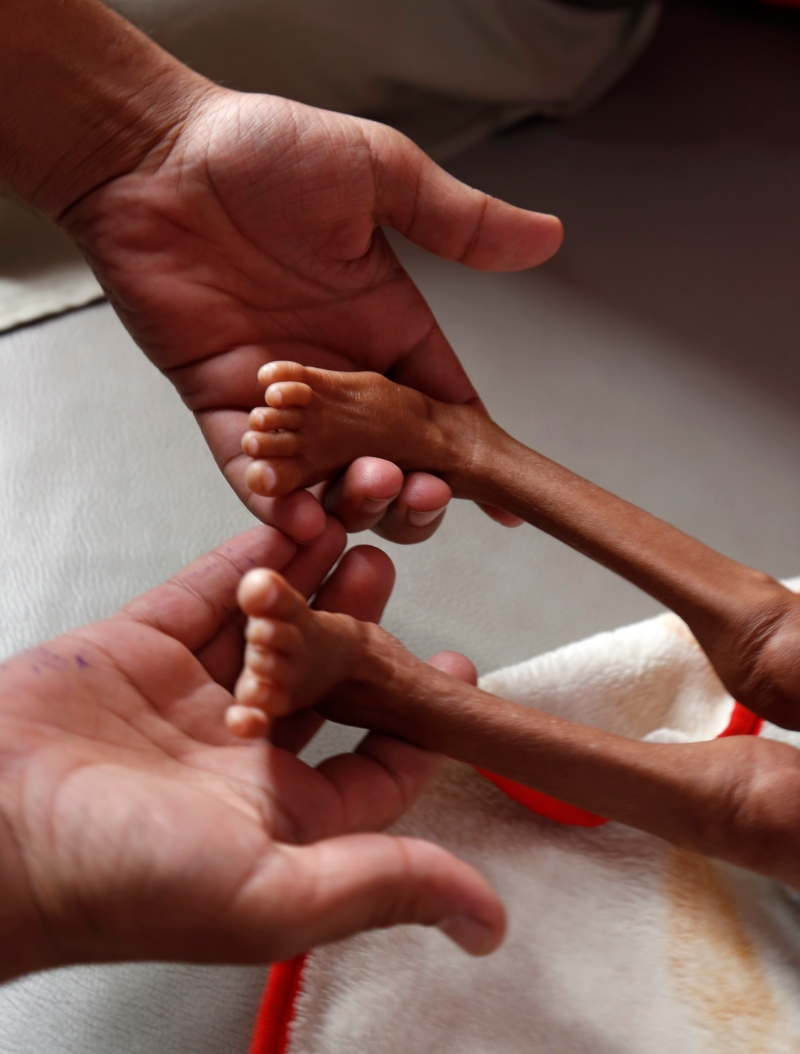 也门百万儿童面临严重营养不良，甚至死亡风险问题。  (新华社照片)