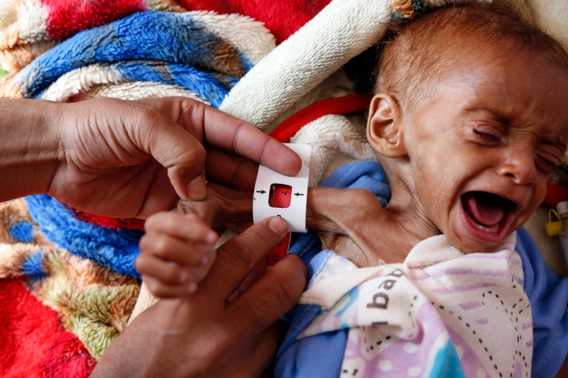 也门首都萨那一家医院，医生为营养不良的儿童做身体检查。(新华社照片)
