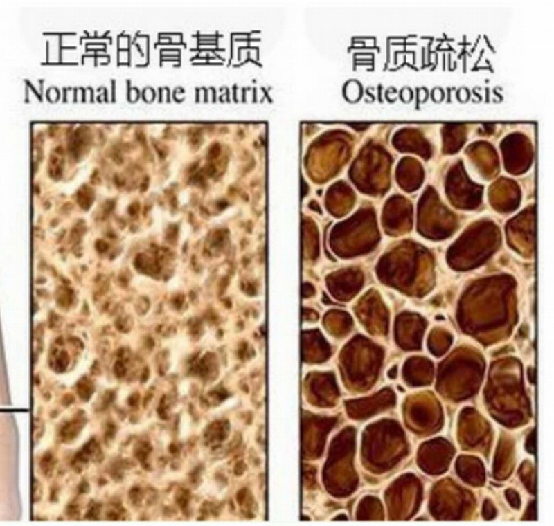 骨骼密度和质量降低，骨骼变得多孔而脆弱，骨折的风险就会大大增加。