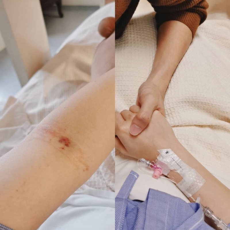 萧丽玲10月31日在脸书放上这张相片，表示心痛男友李伟燊为了她到处奔波，而自己每天都要抽血2次进行检查，现在手上全都是针孔。