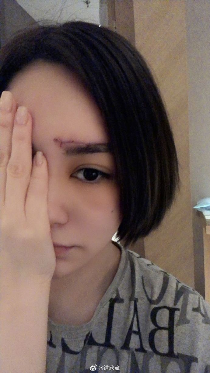 阿娇今年9月在厦门不慎撞伤右眉骨处，伤口几乎跟眉毛一样长。