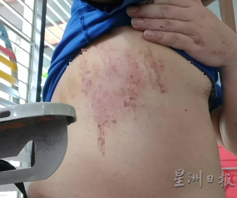 伤者掉入沟渠洞导致右侧肋骨断了三根,目前仍然隐隐作痛。