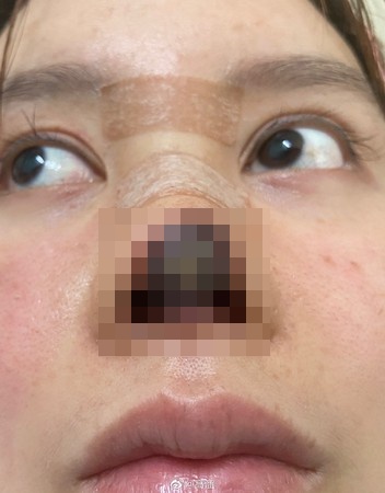 
高溜在去年10月接受鼻子整型手术，未料术后伤口发炎感染，导致鼻头整片发黑坏死。