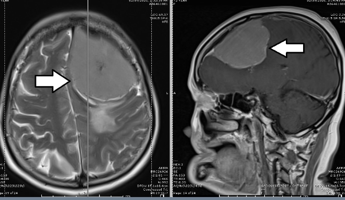 左脑额叶大型脑膜瘤（箭头处） , 造成脑肿和脑压增高，影响语言表达能力，反应变得迟钝。
