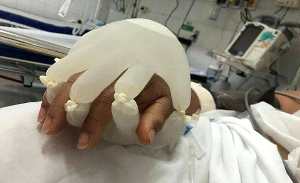 A nurse fills a pair of gloves with warm water and tied the gloves to the hand of a patient as if his family member is holding him.