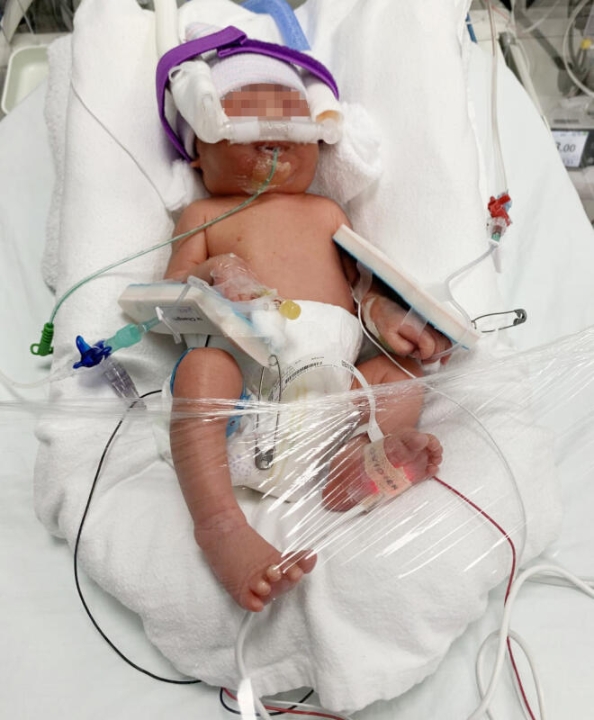 仅有23周大的男婴，因器官尚未发育完全而必须住院；宝宝全身插满插管，令人心疼不己。
