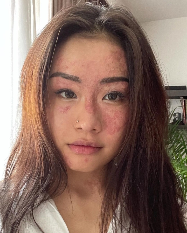 经历半年的治疗，如今从远处已不容易发现莎琳脸上的伤疤，但近处还是可以看到烧伤的痕迹。（取自Charlene Chew Instagram）