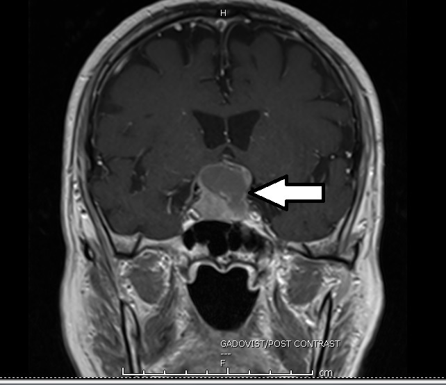 脑下垂体中风（pituitary apoplexy）正面图 , 肿瘤有出血和膨胀现（箭头处）。