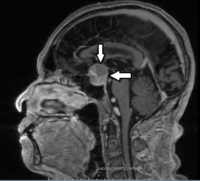 脑下垂体中风（pituitary apoplexy）侧面图, 肿瘤有出血和膨胀现（箭头处）。