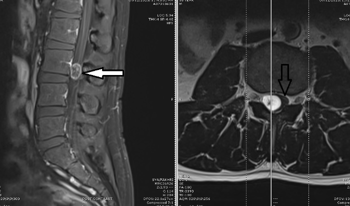 左图：腰椎硬膜外髓肿瘤（箭头处）；右图：肿瘤占据了椎管的大部分空间，神经系统受到压迫（箭头处）。