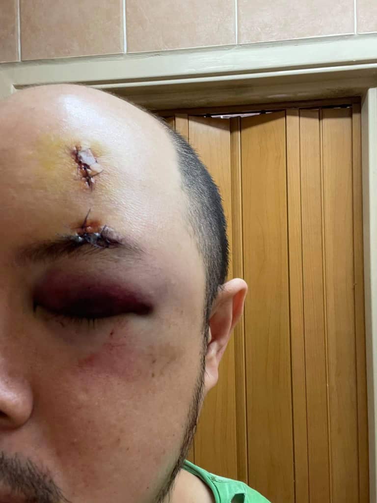 李志雄的额头和右眼在日前发生的轻快铁碰撞事故中受伤，有留疤破相的可能。