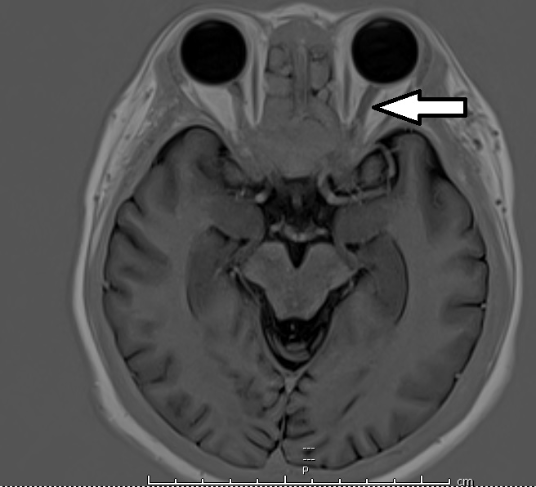 左视神经线有些异常肿胀（箭头）。

