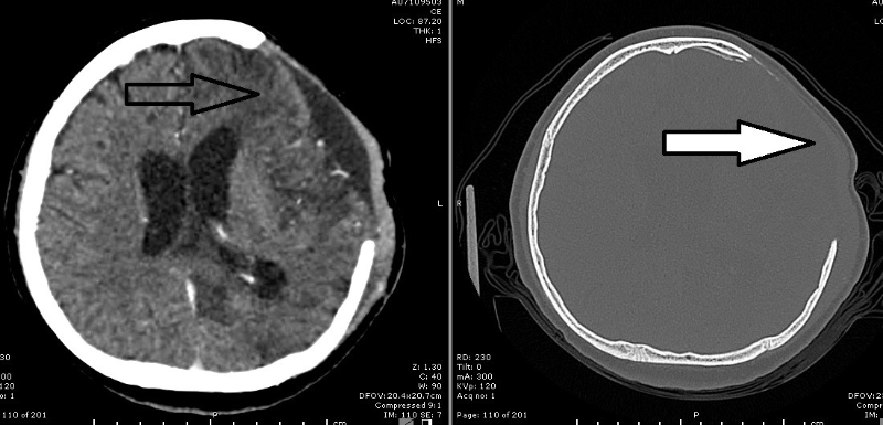 左图：左脑挫伤；右图：颅骨缺口（实心箭头处）。