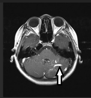 左小脑静脉血管瘤（箭头处）。