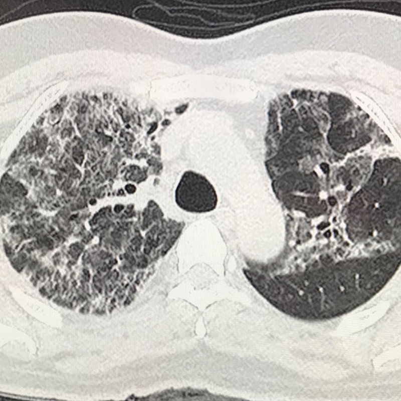 随着病情恶化，“磨影玻璃”会增多、融合，扩大范围，造成多个肺叶出现小斑片，从CT图上看，患者的肺部呈一大片的白色状，医学上称之为“白肺”，这将严重影响肺换气，患者需要持续吸氧。