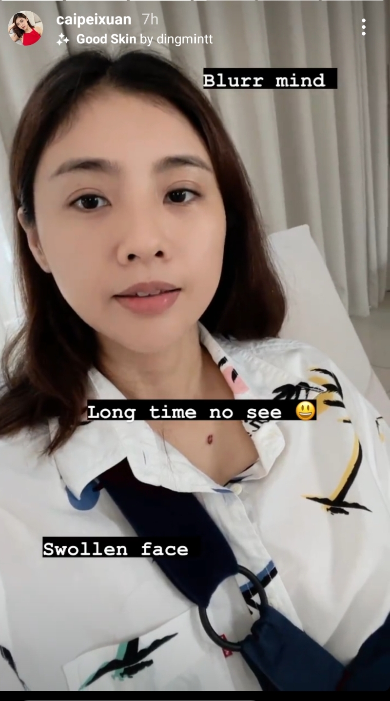 蔡佩璇拍短片自侃说动完手术休息5天后“不清醒”和“肿脸”。
