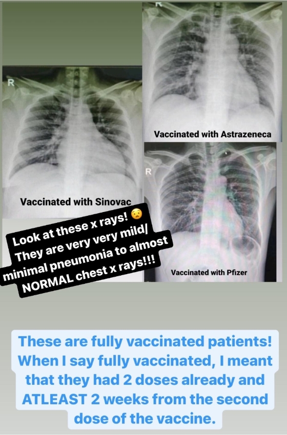 3名已完成分别3种不同疫苗接种的病患，并没有出现肺炎的问题。