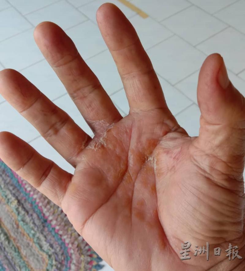 马口商人怀疑自己长期在外使用不同牌子的消毒搓手液，造成手掌脱皮及出现湿疹问题。